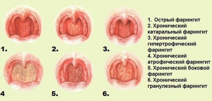 Фарингіт у дітей – симптоми, лікування, причини, профілактика