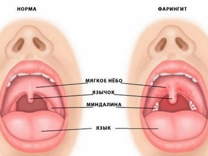 Фарингіт у дітей – симптоми, лікування, причини, профілактика