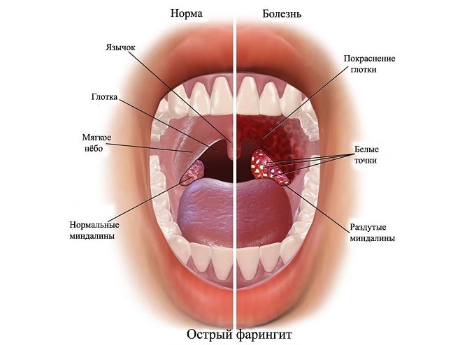 Фарингіт у дітей – симптоми, лікування, причини, профілактика