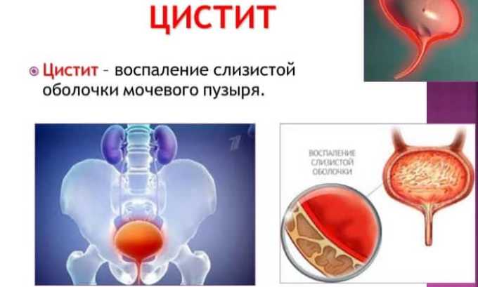 Фурамаг при циститі — інструкція із застосування, протипоказання та відгуки