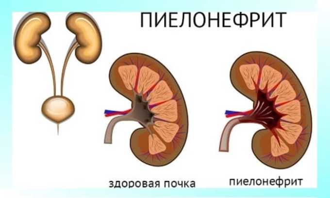 Фурамаг при циститі — інструкція із застосування, протипоказання та відгуки