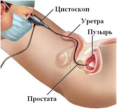 Гематурія (кров у сечі у чоловіків): що це може бути, причини, що робити