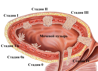 Гематурія (кров у сечі у чоловіків): що це може бути, причини, що робити