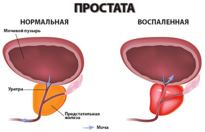 Гематурія (кров у сечі у чоловіків): що це може бути, причини, що робити