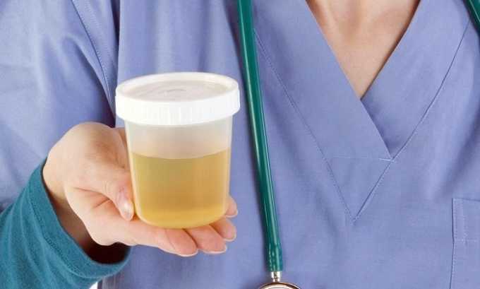 Головні відмінності циститу від молочниці