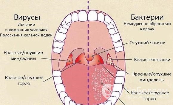 Гострий фарингіт краще попередити чим лікувати