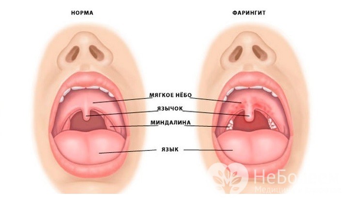 Гострий фарингіт краще попередити чим лікувати