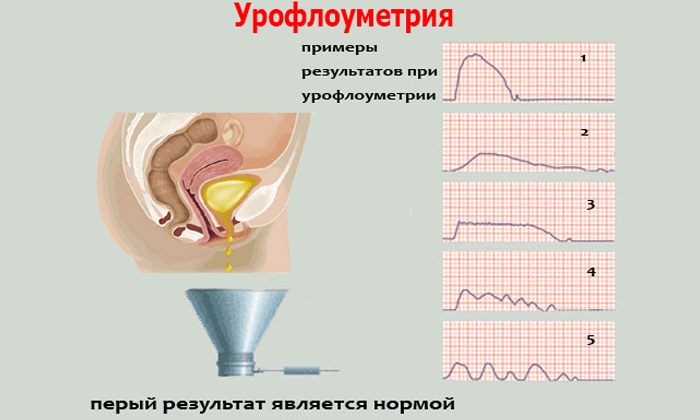 Гранулярний цистит лікування – лікування потнеции