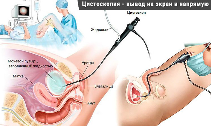 Гранулярний цистит лікування – лікування потнеции
