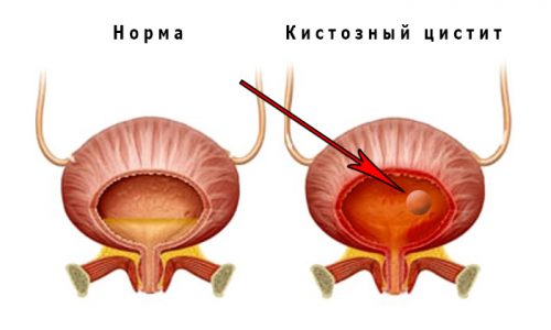 Гранулярний цистит лікування – лікування потнеции Гранулярний цистит лікування – лікування потнеции