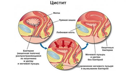 Гранулярний цистит лікування – лікування потнеции
