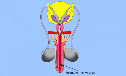 Гранулярний цистит лікування – лікування потнеции Гранулярний цистит лікування – лікування потнеции