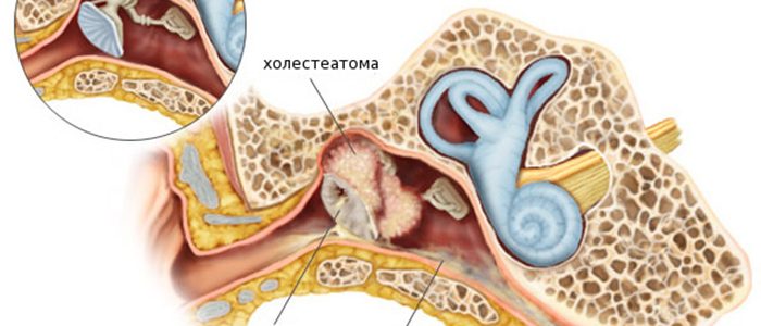 Холестеатома середнього вуха