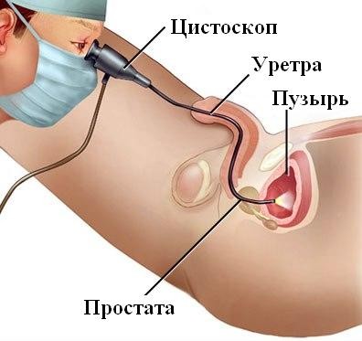 Хронічний цистит у жінок симптоми і лікування Хронічний цистит у жінок симптоми і лікування