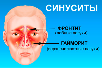 Хронічний риніт (гіпертрофічний форми риніту)