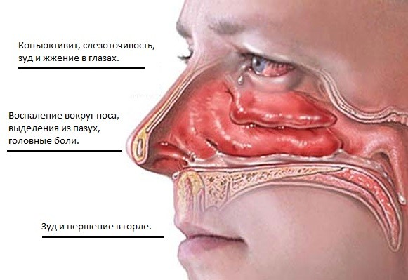 Хронічний риніт: симптоми і лікування нежиті