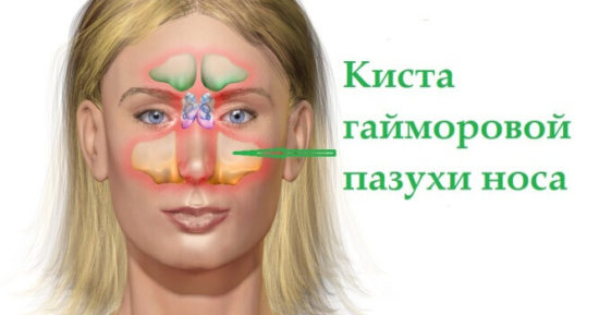 Кістозний гайморит симптоми і лікування