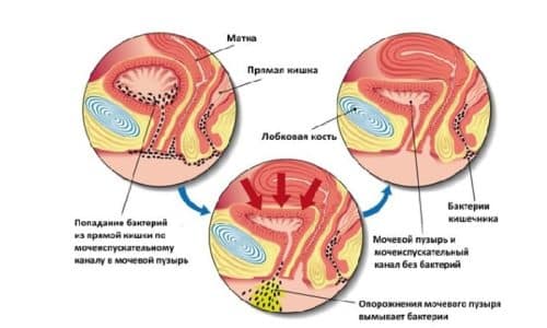 Кандидозний цистит симптоми у жінок
