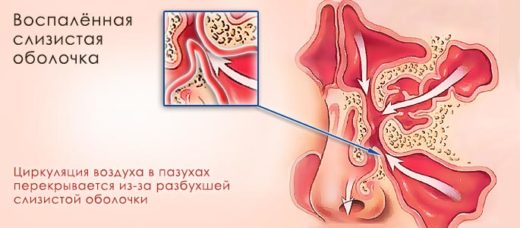 Катаральний гайморит: симптоми, лікування, що таке