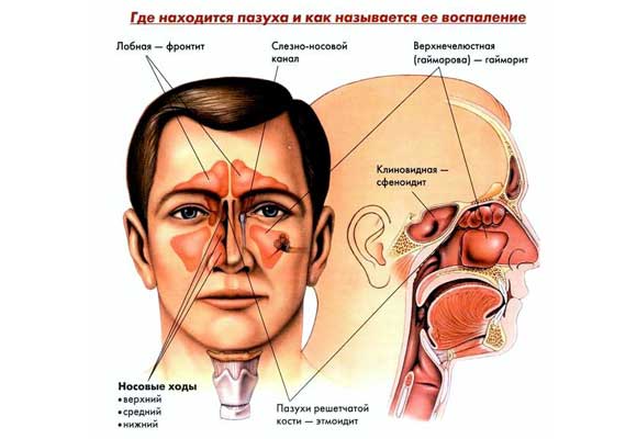 Катаральний гайморит: симптоми, лікування, що таке
