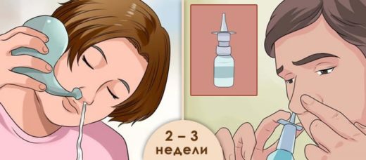 Катаральний гайморит: симптоми, лікування, що таке