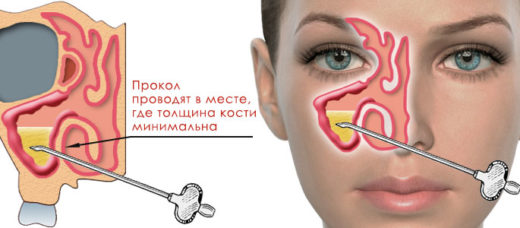 Катаральний гайморит: симптоми, лікування, що таке