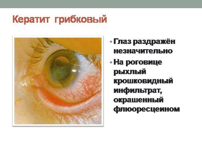 Кератит лікування народними засобами