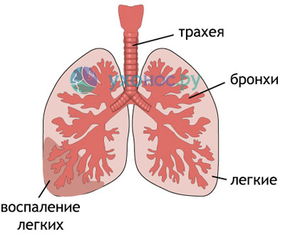 Клебсієла пневмонія: причини, симптоми і лікування