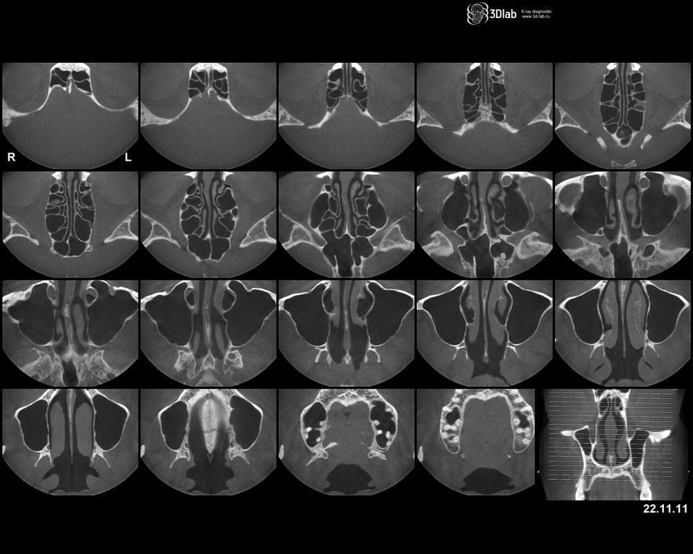 КТ придаткових пазух носа – Комп’ютерна томографія пазух носа