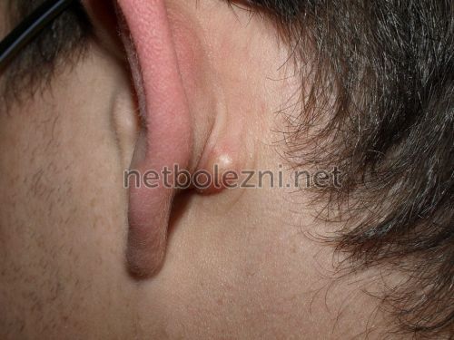 Кулька в мочці вуха – що це, які способи лікування, як позбавитися від шишки