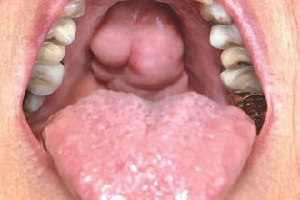 Лікування аденоїдів у дітей народними засобами