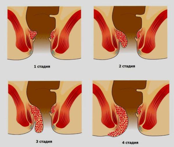 Лікування геморою у жінок в домашніх умовах народними засобами і методами (способами), як і чим лікувати?