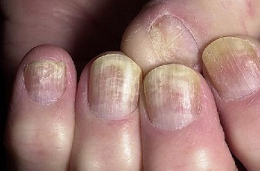 Лікування грибка нігтів оніхомікозу народне і медикаментозне Лікування грибка нігтів оніхомікозу народне і медикаментозне