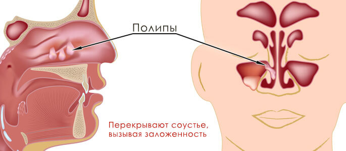 Лікування кістозного гаймориту Лікування кістозного гаймориту