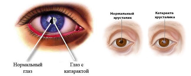 Лікування катаракти народними засобами в домашніх умовах