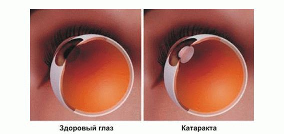 Лікування катаракти народними засобами в домашніх умовах