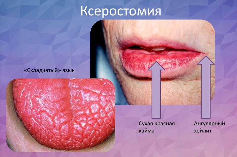 ЛІКУВАННЯ КСЕРОСТОМІЇ – Ксеростомія як симптом при патології органів і систем