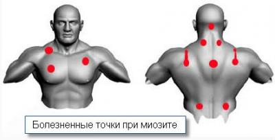 Лікування міозиту м’язів в домашніх умовах