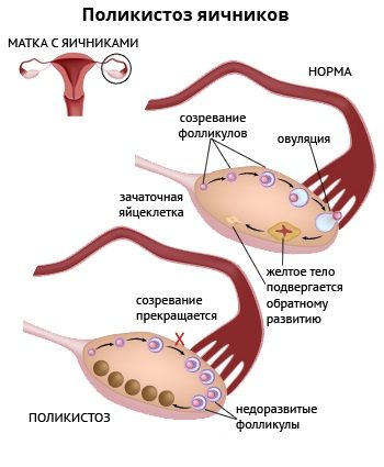 Лікування народними засобами полікістозу яєчників