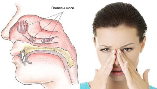 Лікування поліпів у носі з допомогою народних засобів
