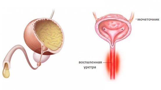 Лікування уретриту у чоловіків в домашніх умовах народними засобами