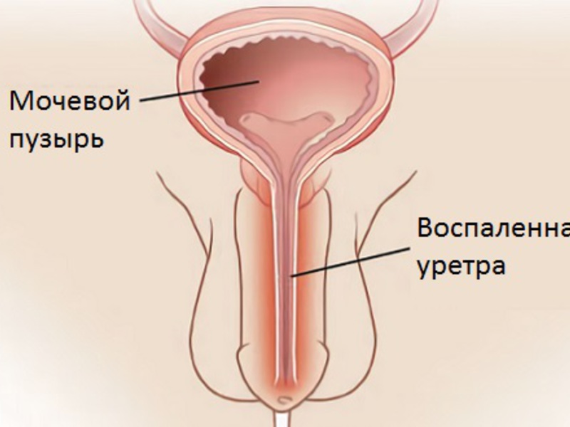 Лікування уретриту у чоловіків в домашніх умовах народними засобами