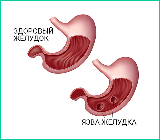 Лікування виразки шлунка народними засобами в домашніх умовах