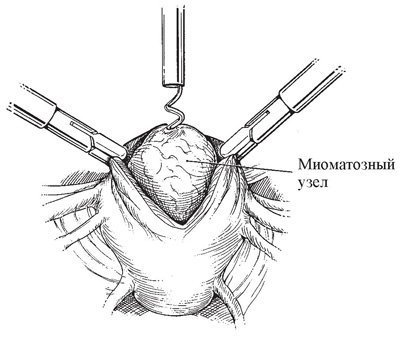 Лапароскопічна і консервативна міомектомія