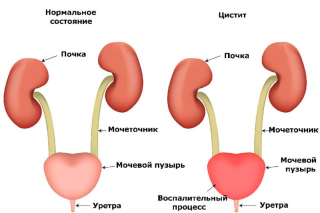 Мед при циститі у жінок: способи лікування і рецепти