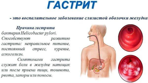 Мед при гастриті можна чи ні