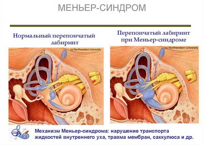 Методи лікування вушної хвороби Меньєра