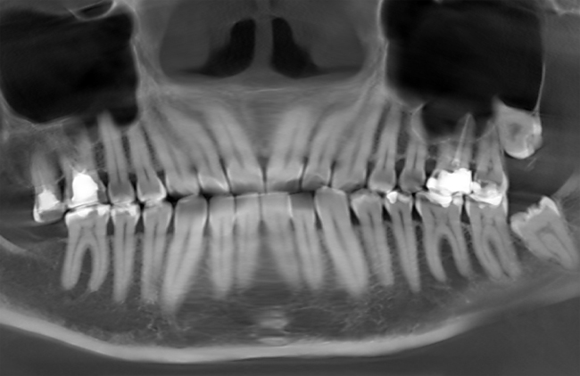 Може зубний біль віддавати в вухо заклало одночасно з одного боку, що робити з за зуба болить скроню