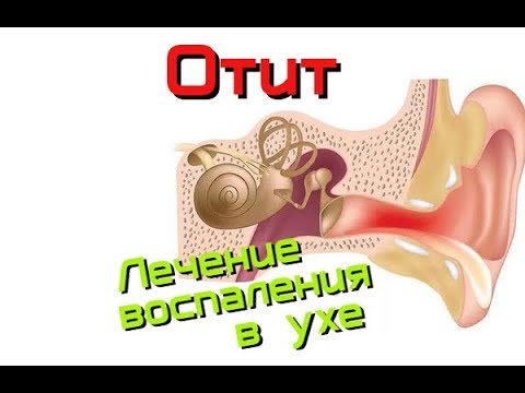 Чи можна капати препарат Отипакс в ніс від нежитю чи ні