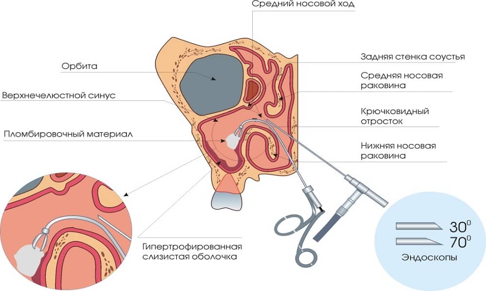 Чим зняти сильні болі при гаймориті